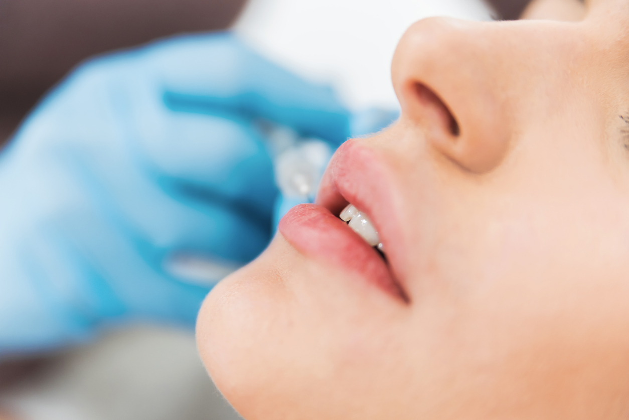 Close-up of woman’s lips with a gloved hand holding a needle in the background demonstrating dissolving lip filler.