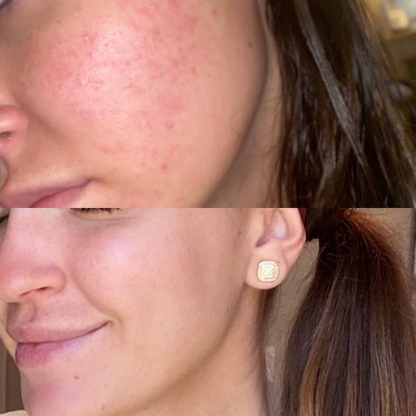 A before an after shot of a woman's cheek cleared of acne.