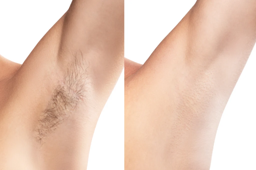 A before-and-after comparison of underarm hair reduction demonstrates the effectiveness of laser hair removal treatment.