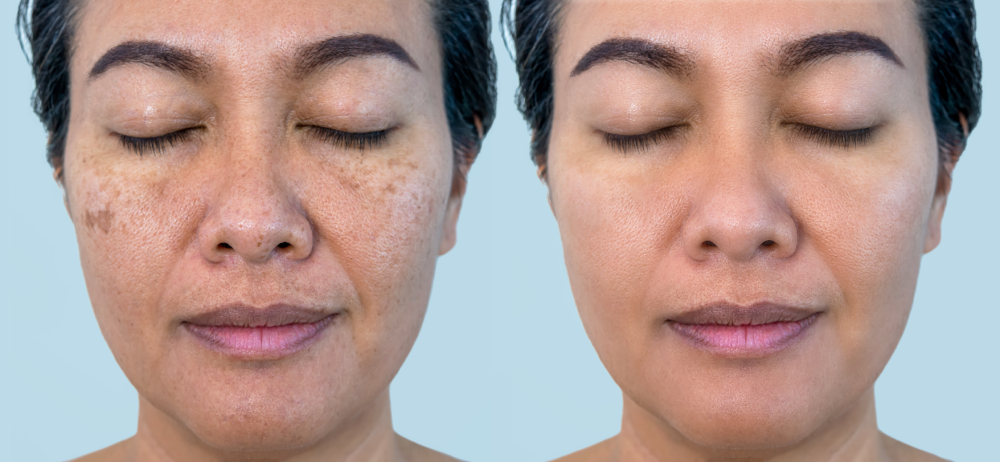 Before and after comparison of skin after HydraFacial.