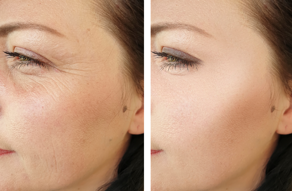 Microneedling before and after transformation close-up.