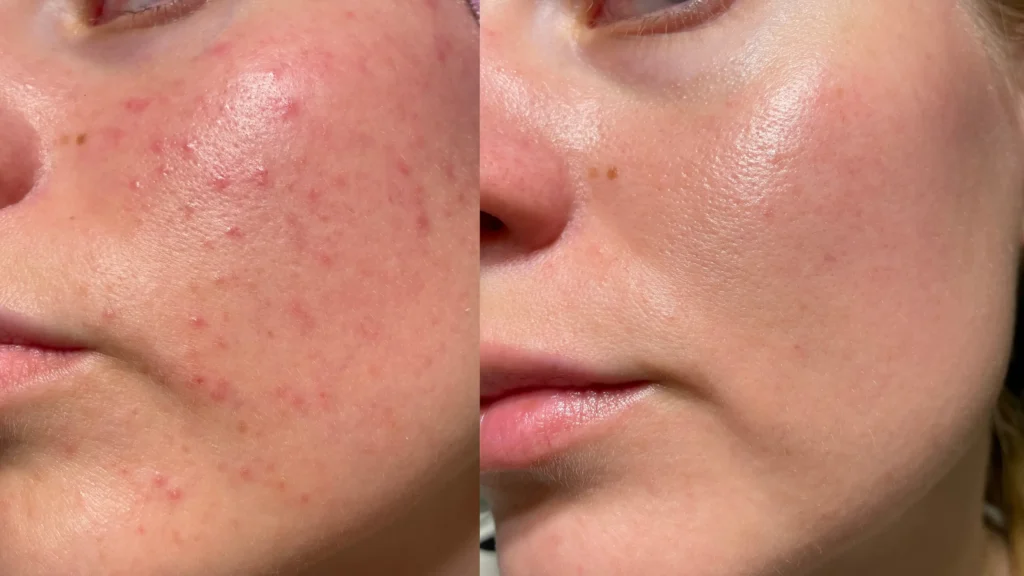 Side-by-side facial comparison showing visible differences in redness and skin texture